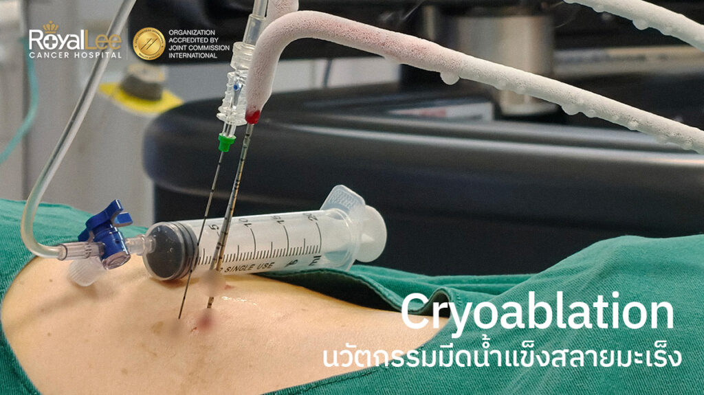 Cryoablation นวัตกรรมมีดน้ำแข็งสลาย สู้มะเร็งด้วยทางเลือกใหม่ที่ 'เจ็บน้อยกว่า'