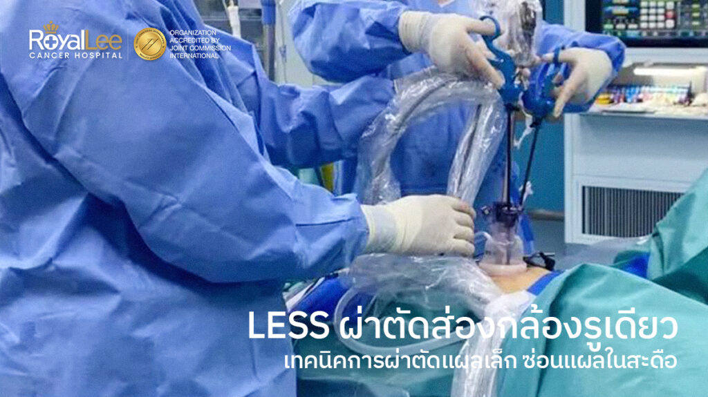 LESS ผ่าตัดส่องกล้องรูเดียว นวัตกรรมซ่อนแผลในสะดือ