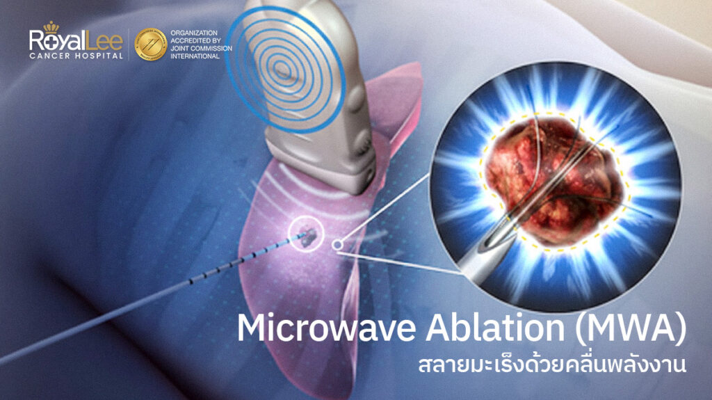  Microwave Ablation (MWA) สลายมะเร็งด้วยคลื่นไมโครเวฟพลังงานสูง