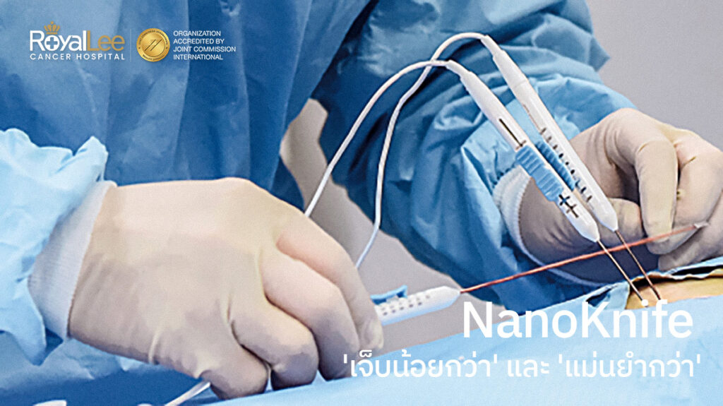 NanoKnife หรือทางชื่อทางการแพทย์คือ Irreversible Electroporation (IRE)