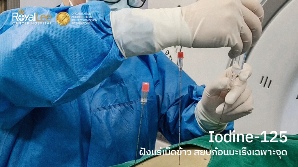 Iodine-125 ฝังแร่เม็ดข้าว สยบก้อนมะเร็งเฉพาะจุด