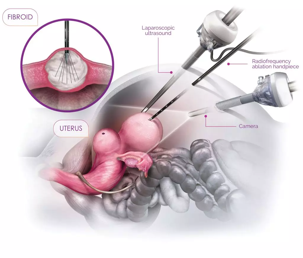 Microwave Ablation (MWA)