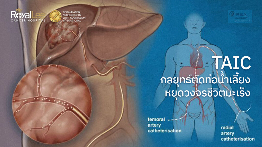 TACE กลยุทธ์ตัดท่อน้ำเลี้ยง หยุดวงจรชีวิตมะเร็ง
