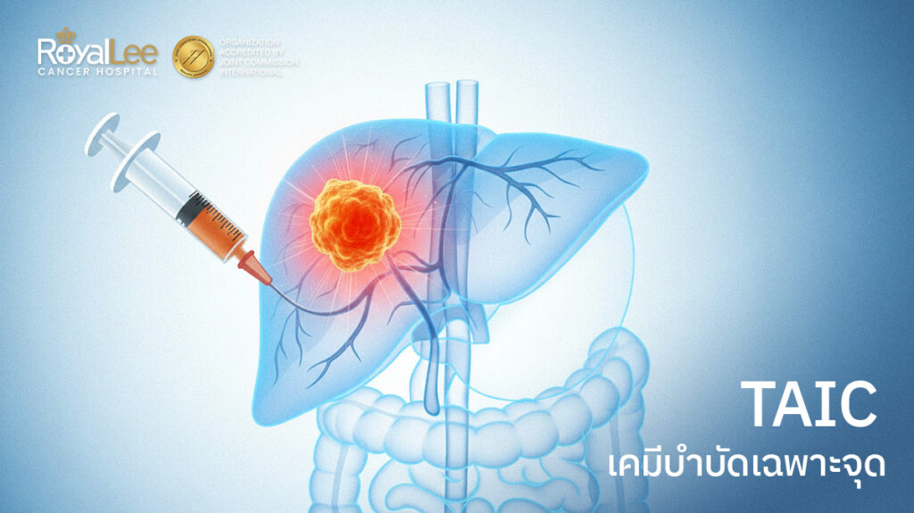 เคมีบำบัดเฉพาะจุด ล็อกเป้ามะเร็งร้ายไม่ทำลายเซลล์ดี