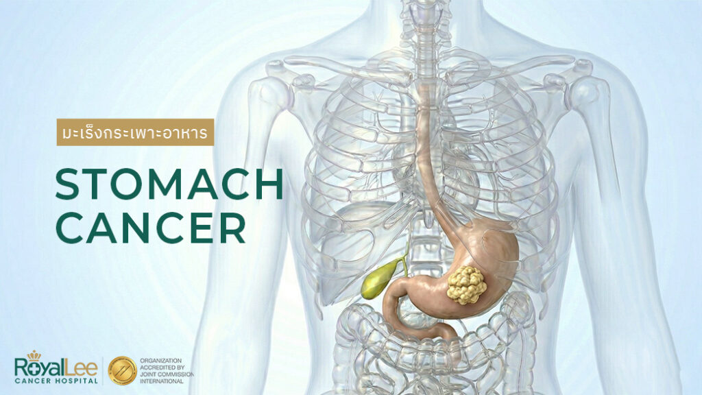 มะเร็งกระเพาะอาหาร Stomach Cancer