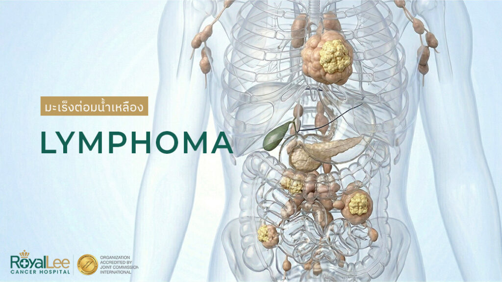 มะเร็งต่อมน้ำเหลือง Lymphoma