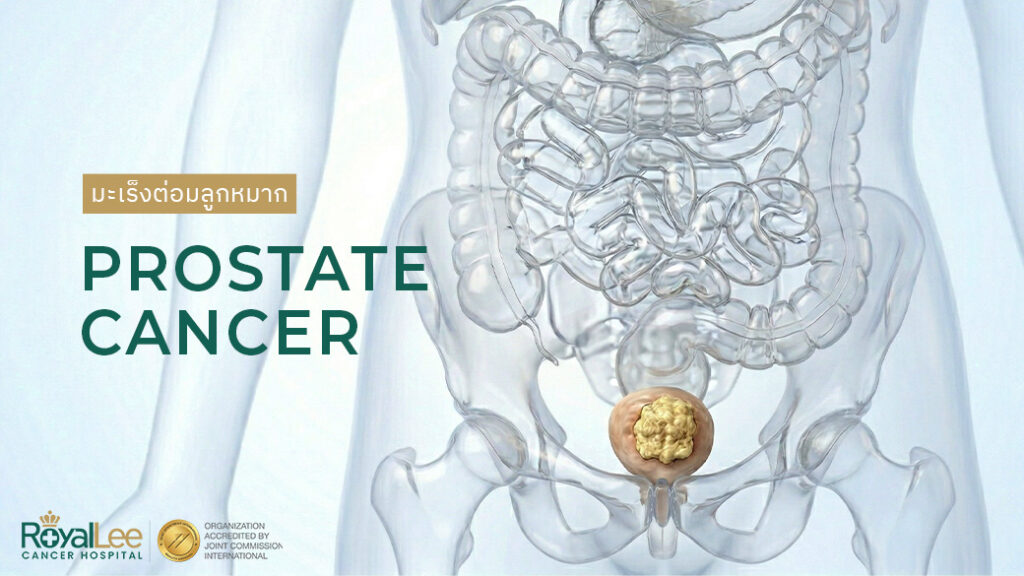 มะเร็งต่อมลูกหมาก Prostate Cancer