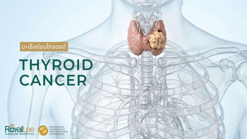 มะเร็งต่อมไทรอยด์ Thyroid Cancer