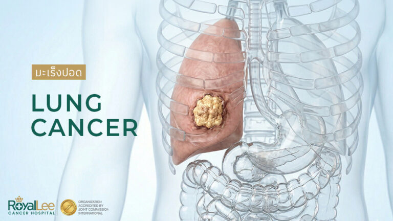 มะเร็งปอด Lung Cancer