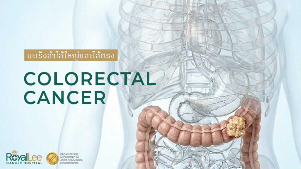 มะเร็งลำไส้ใหญ่และไส้ตรง Colorectal Cancer