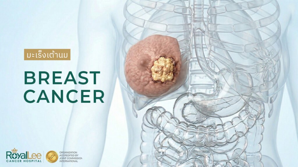 มะเร็งเต้านม Breast Cancer