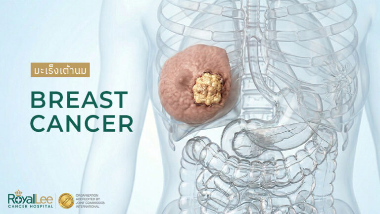 มะเร็งเต้านม Breast Cancer